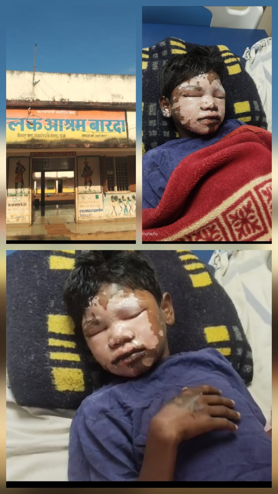 बालक आश्रम बारदा में किचन की गर्म तेल से जल गया छात्र